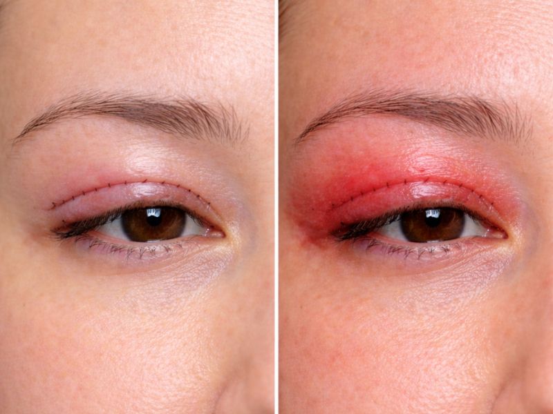 Nhận biết dấu hiệu mí mắt sưng viêm sau cắt mí, để có cách xử lý kịp thời