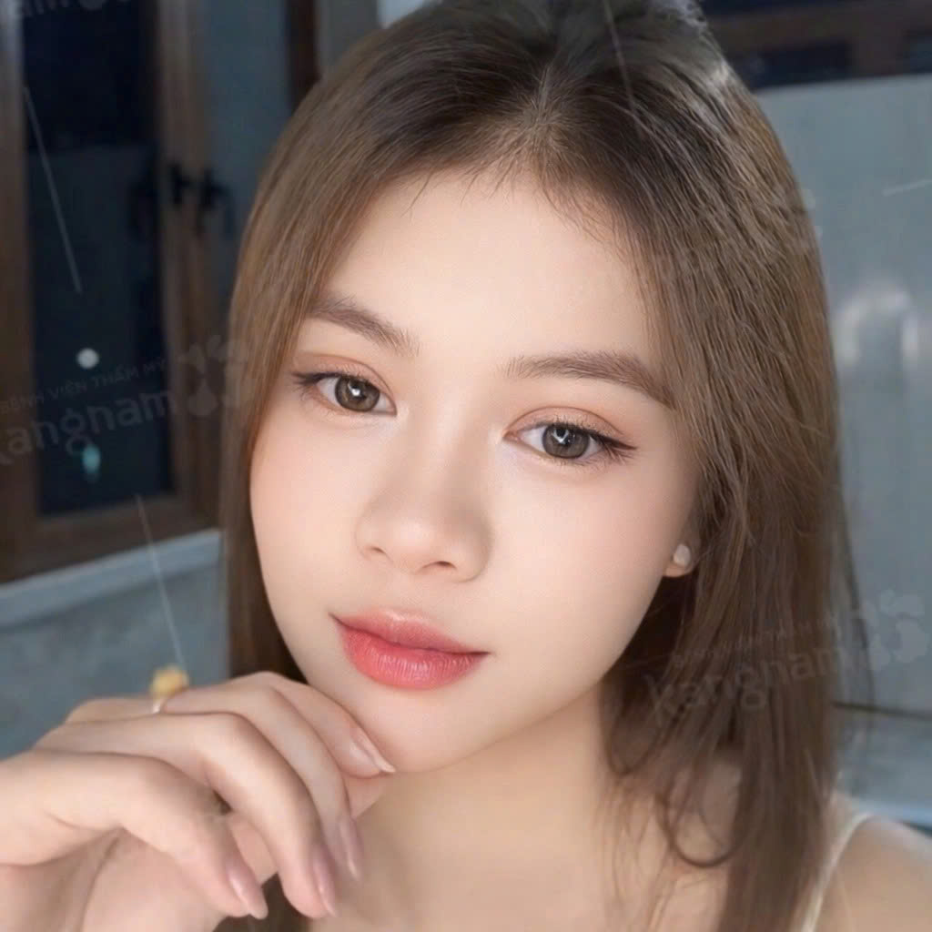 Sau 7 ngày nếp mí cân đối, to tròn tự nhiên