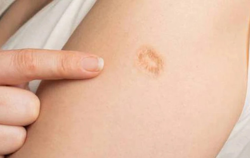 Sẹo lõm bề mặt da bắp tay do hút mỡ quá sâu, ảnh hưởng thẩm mỹ