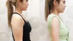 Chi phí hút mỡ bắp tay 2026: Bảng giá trọn gói và cách tránh chi phí phát sinh