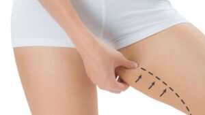 Chi phí hút mỡ đùi trọn gói 2026: Cập nhật 2 mức giá mới nhất và 5 lưu ý