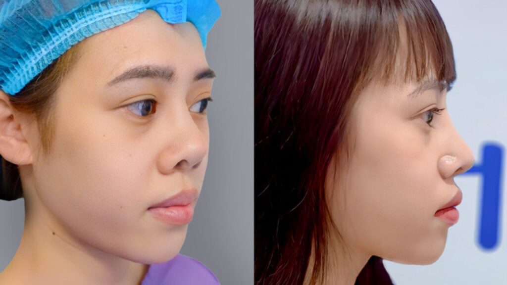 Giá nâng mũi sửa lại bao nhiêu tiền? Bảng giá theo tình trạng mũi hỏng