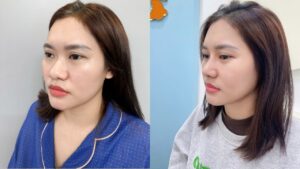 Phương Hằng “lột xác” sau Nâng mũi Nanoform cùng BS. Henry Nguyễn