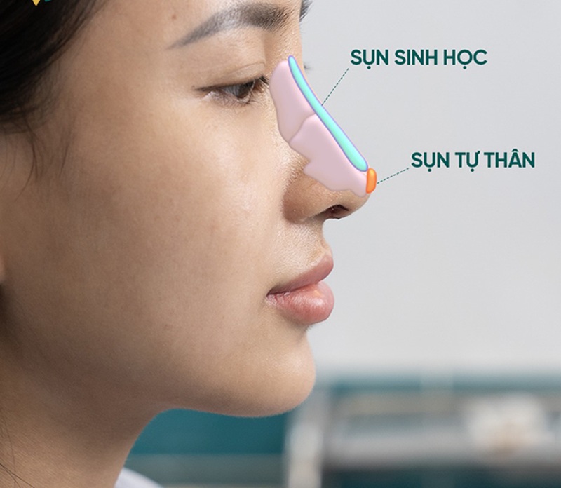 Nhầm lẫn giữa sụn nhân tạo và sụn tự thân ở nhiều người