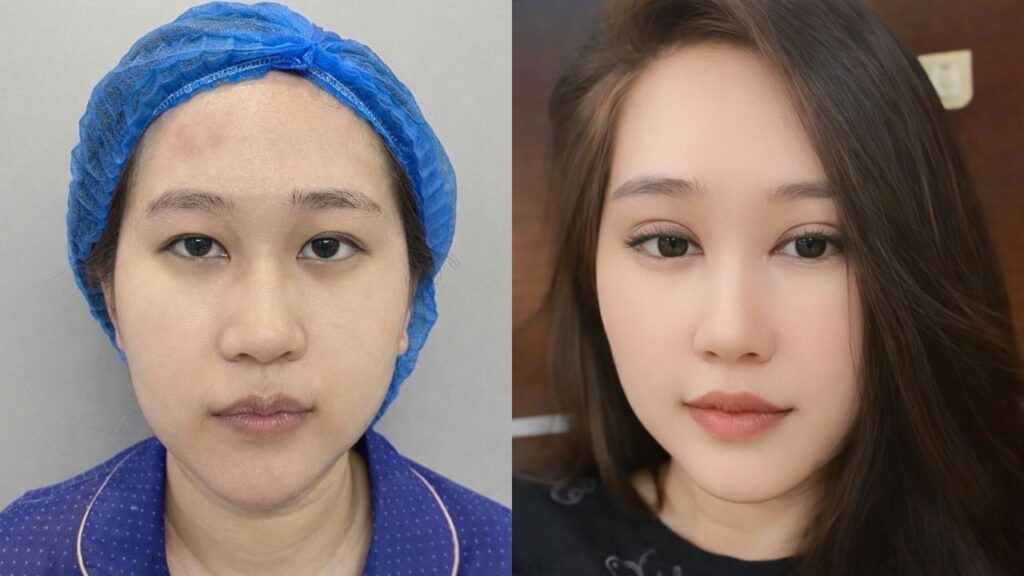 Chỉnh hình mắt sụp mí bẩm sinh cùng Hương Quỳnh tại Kangnam Hà Nội