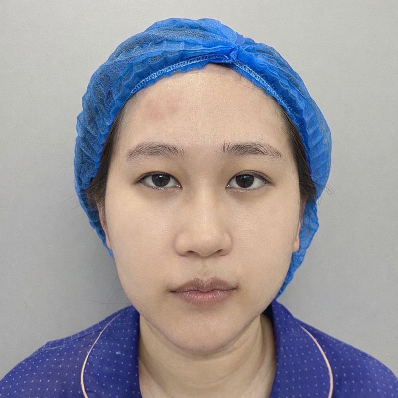 Quỳnh gặp tình trạng sụp mí bẩm sinh