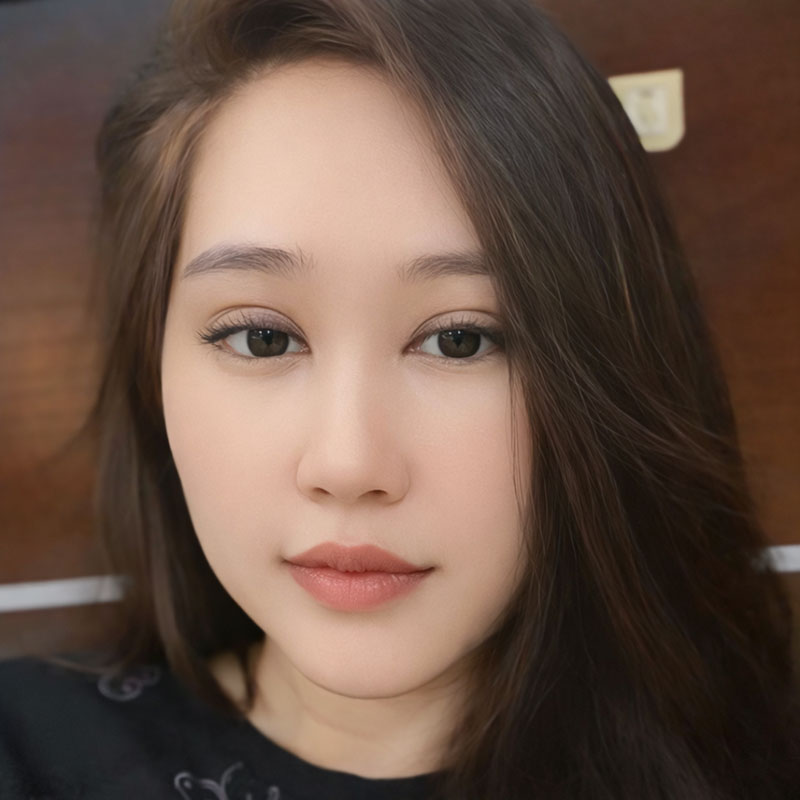 Nếp mí sau khi can thiệp chỉnh sửa 5 ngày