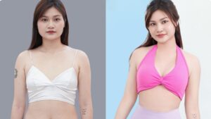 Hút mỡ bao lâu đi làm lại được? 3–7 ngày hay 1 tháng? Bác sĩ giải đáp chi tiết