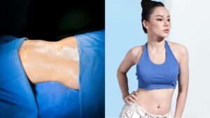 Hút mỡ bao lâu ổn định? Phân biệt 3 giai đoạn Viêm – Tăng sinh – Tái cấu trúc mô mềm