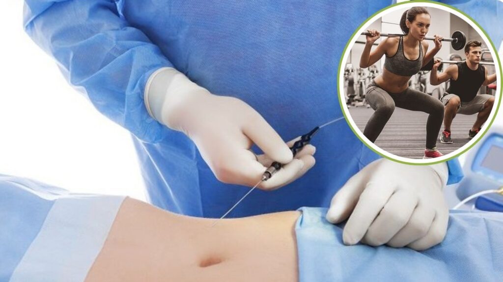 Hút mỡ bao lâu tập Gym được? Lộ trình vận động 4 giai đoạn từ Bác sĩ Kangnam