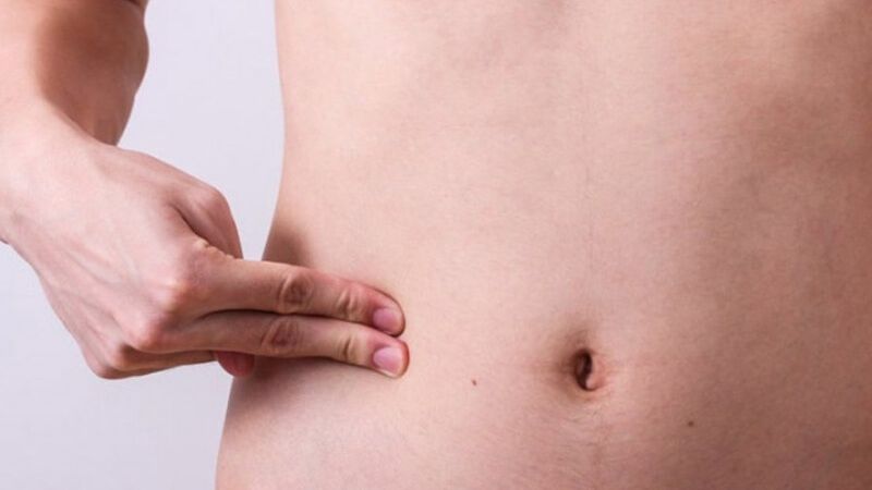 Cứng bụng sau hút mỡ thường do bị phù nề, tụ dịch dấu hiệu nhân biết cơ thể đang hồi phục 