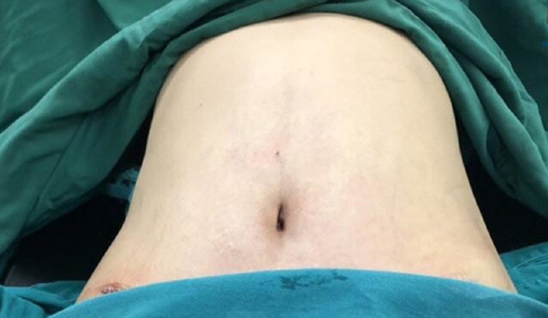 Hút mỡ bị lồi lõm da gồ ghề, sóng da hoặc lõm không đều do hút mỡ sai kỹ thuật, xơ hóa mô