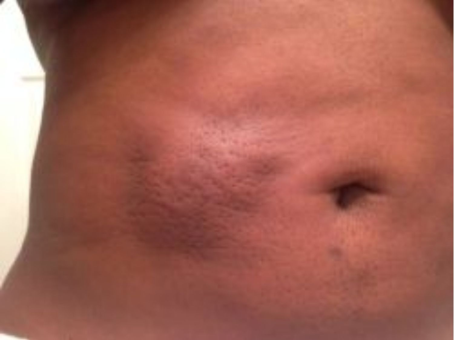 tụ dịch là dịch trong hoặc vàng nhạt và diễn tiến chậm hơn tụ máu, ảnh minh họa tụ dịch vùng bụng