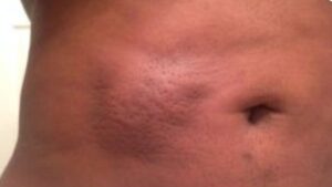 Hút mỡ bị tụ dịch có nguy hiểm không? Cách phân biệt sưng nề sinh lý và tụ dịch cần chọc hút