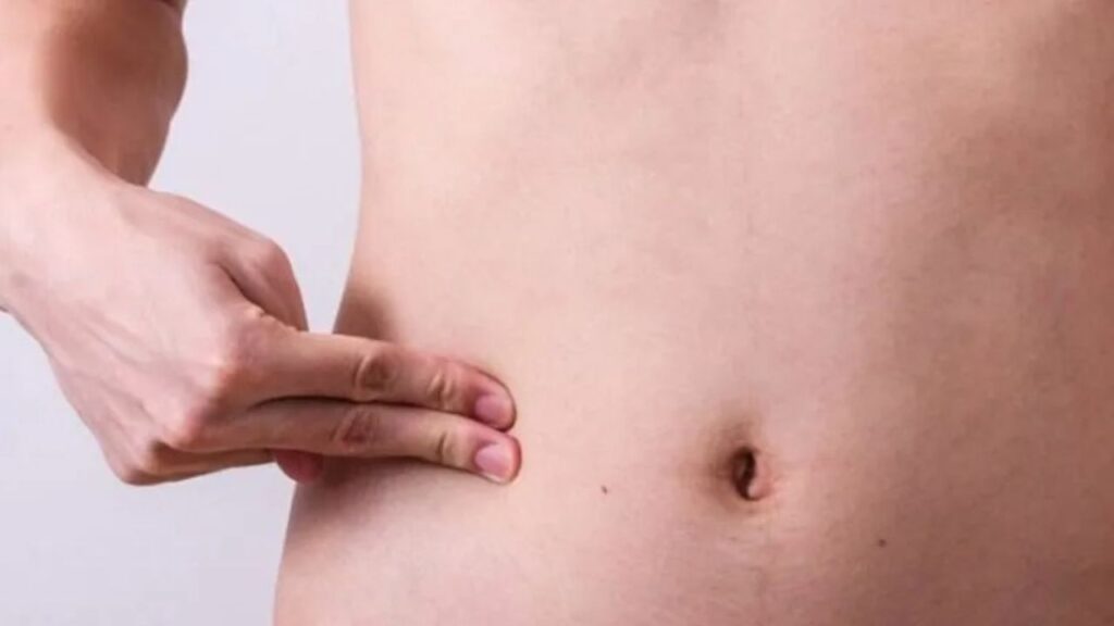 Hút mỡ bao lâu tan dịch? Phân biệt rỉ dịch sinh lý và tụ dịch theo chỉ dẫn y khoa