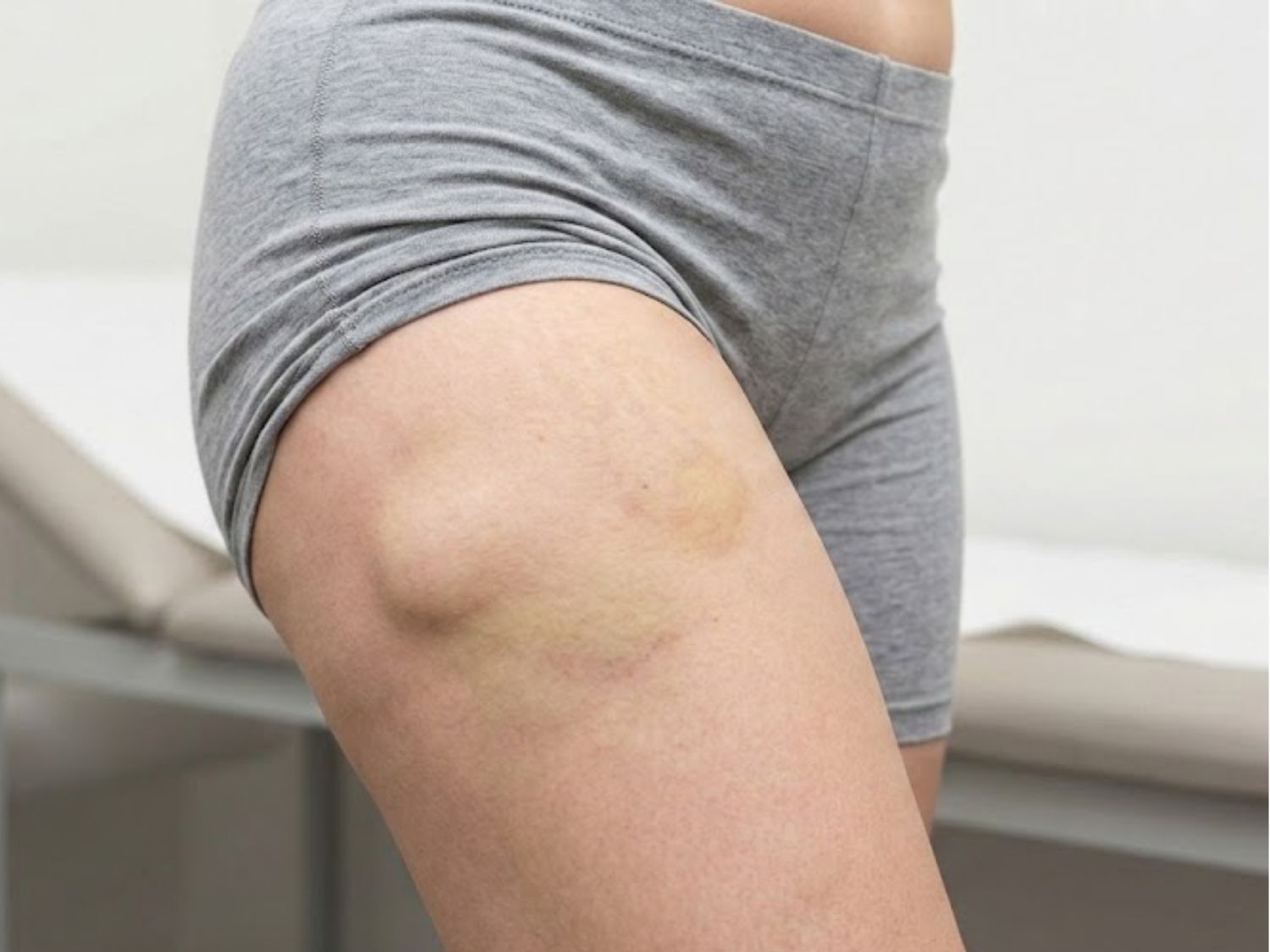 tình trạng tụ dịch sau khi hút mỡ đùi do hệ bạch huyết bị gián đoạn sau hút mỡ