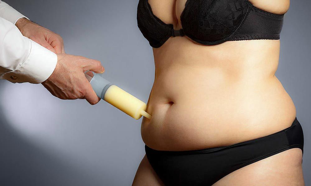 Da chùng, nhiều mỡ thừa ở lớn tuổi vẫn có thể hút mỡ, tạo hình thành bụng
