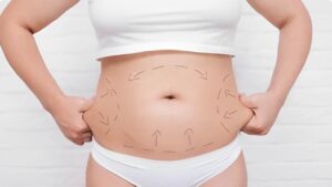 Hút mỡ bụng có nguy hiểm không? Sự thật về tỷ lệ rủi ro bạn cần biết