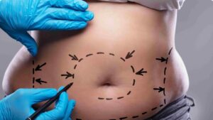 Hút mỡ bụng dưới: Giải pháp cho vùng mỡ khó trị nhất và 8 lưu ý y khoa