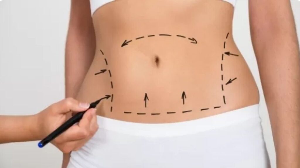 Hút mỡ bụng trên: Giảm 3-8cm vòng bụng và sự thật về mỡ nội tạng