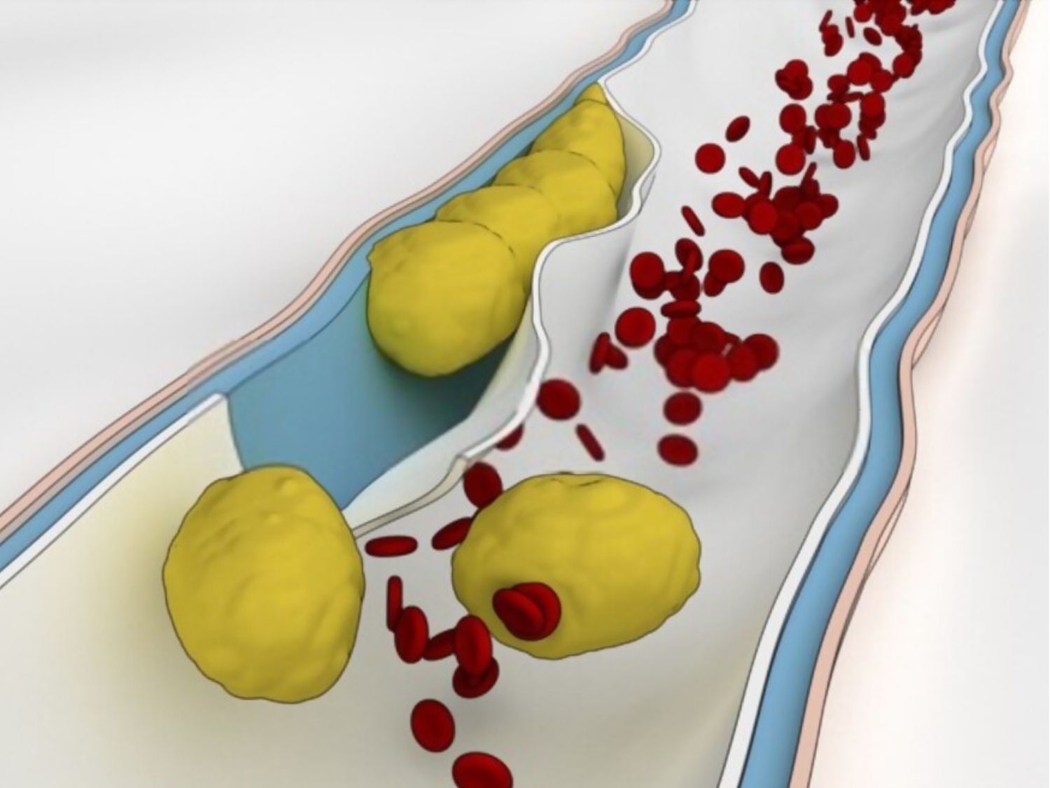 mô phỏng tình trạng Thuyên tắc mỡ, tình trạng này có thể gián tiếp làm ảnh hưởng đến các cơ quan nội tạng