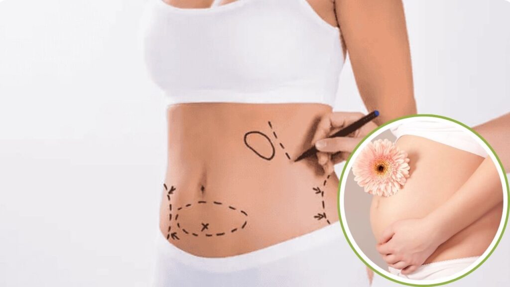 Hút mỡ có ảnh hưởng đến khả năng sinh sản không? Giải đáp từ Bác sĩ Thẩm mỹ