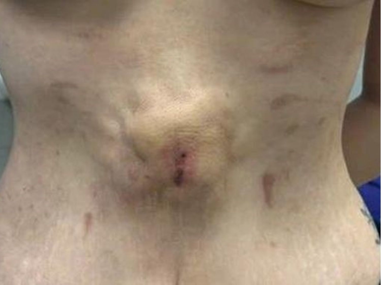 tình trạng da lồi lõm sau hút mỡ do thực hiện tại cơ sở kém uy tín