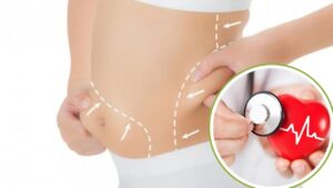 Hút mỡ có ảnh hưởng tim mạch không? Phân tích rủi ro & Điều kiện an toàn 2026