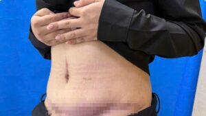 Hoại tử da sau hút mỡ: Dấu hiệu nhận biết sớm và Quy trình xử lý chuẩn y khoa 2026