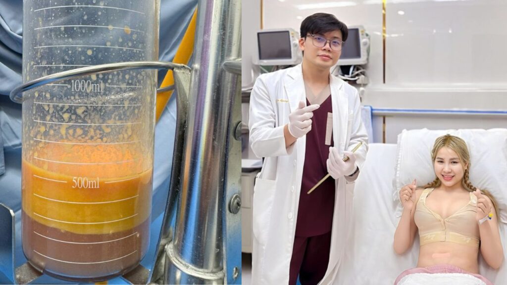 Hút mỡ có cần nằm viện không? Quy trình hồi sức và Timeline đi làm lại an toàn