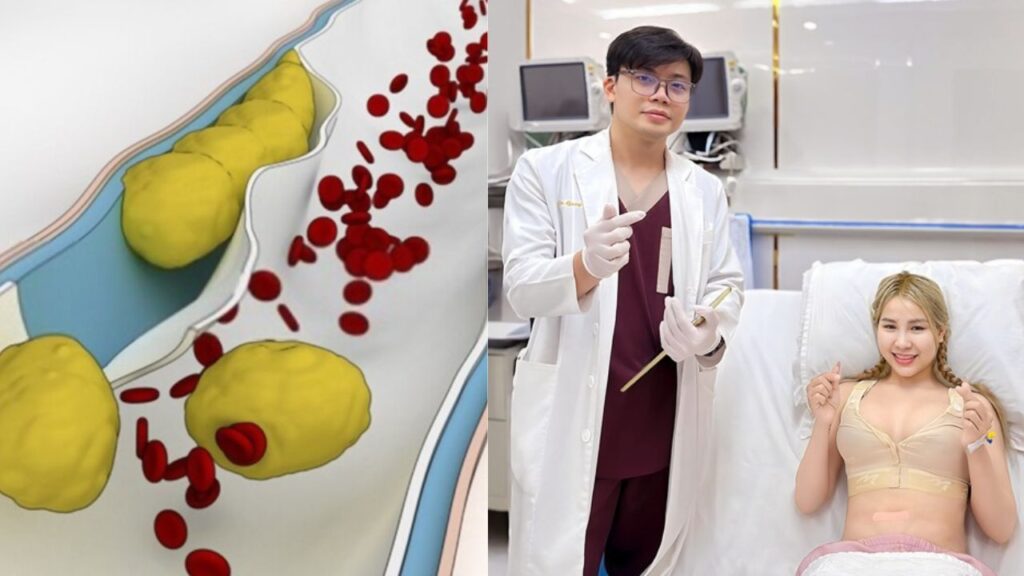 Hút mỡ có chết không? Phân tích nguyên nhân tai biến & Quy trình kiểm soát rủi ro 2026