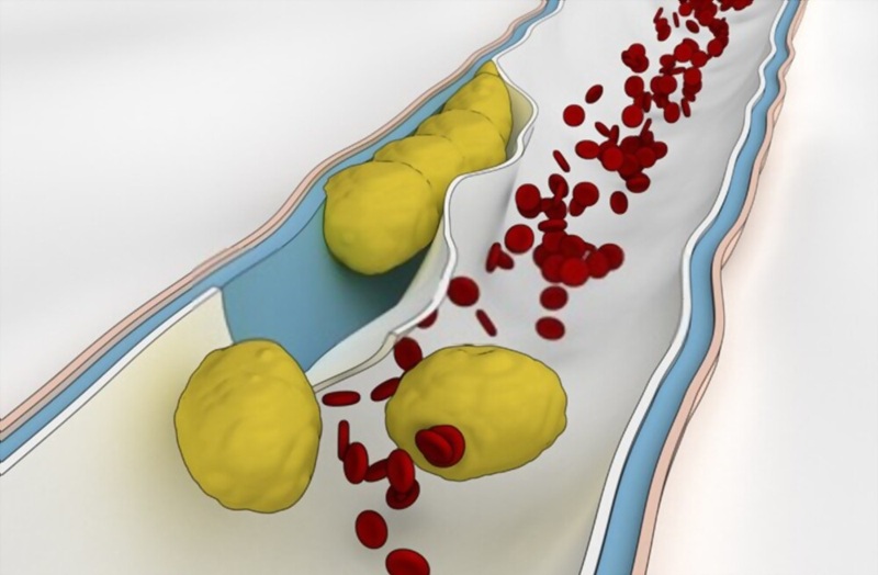 Thuyên tắc mạch mỡ là biến chứng nguy hiểm khi hút mỡ có thể ảnh hưởng tới