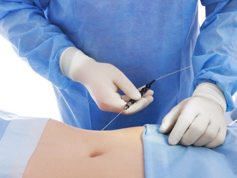Hút mỡ không đau trong quá trình thực hiện vì được bác sĩ gây mê trước khi thực hiện