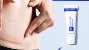 Hút mỡ có để lại sẹo không? Vị trí giấu sẹo và 4 giai đoạn mờ sẹo tàng hình