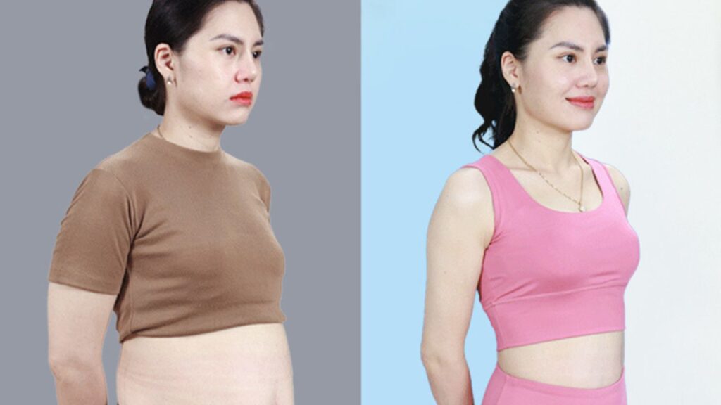 Hút mỡ có hiệu quả không? Lộ trình giảm 3-8cm vòng bụng sau 60 phút