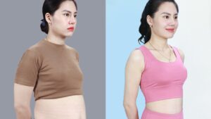 Hút mỡ có hiệu quả không? Lộ trình giảm 3-8cm vòng bụng sau 60 phút