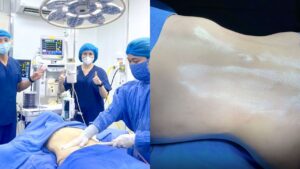 Hút mỡ có làm lồi lõm da không? Nguyên nhân và cách xử lý