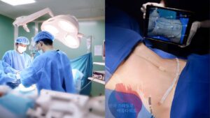 Hút mỡ là đại phẫu hay tiểu phẫu? Phân tích mức độ xâm lấn và rủi ro y khoa 2026