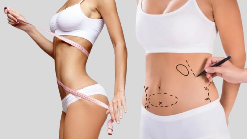 Khi trọng lượng cơ thể tăng có thể khiến tái béo dù đã hút mỡ