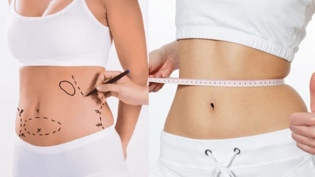 Tế bào mỡ có mọc lại sau khi hút không? Sự khác biệt giữa hút mỡ và giảm cân tự nhiên