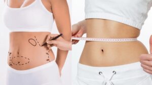 Tế bào mỡ có mọc lại sau khi hút không? Sự khác biệt giữa hút mỡ và giảm cân tự nhiên