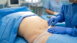 Hút mỡ có để lại vết rạch lớn không? Vết mổ dài bao nhiêu mm
