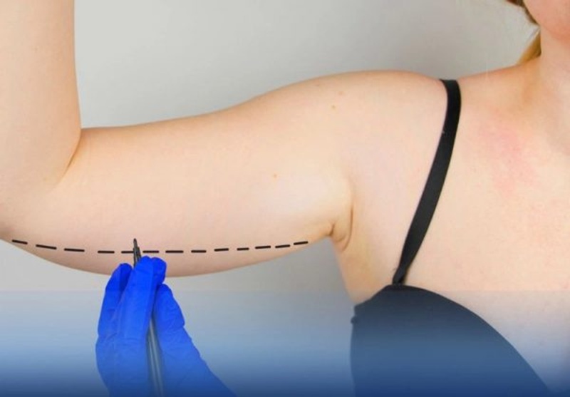 Bác sĩ tiêm trực tiếp thuốc tê vào vùng bắp tay trước khi thực hiện hút mỡ vùng bắp tay