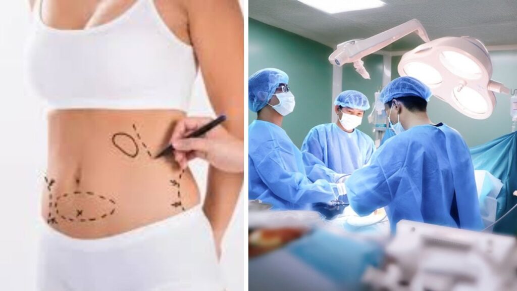 Hút mỡ gây mê hay gây tê? Quy trình vô cảm an toàn cho từng vùng mỡ