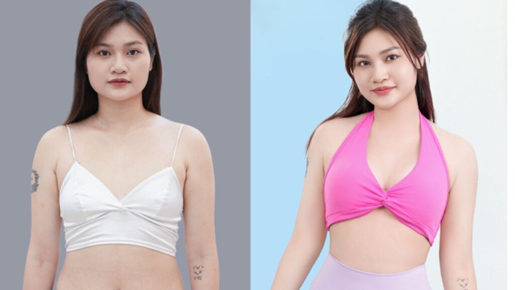 Hút mỡ giữ được bao lâu? Sự thật về kết quả vĩnh viễn và cơ chế tái béo