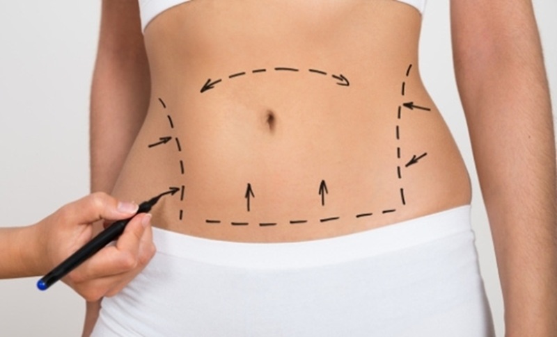 Tăng cân hoặc dấu hiệu tuổi tác khiến vùng da chùng xuống cần phải hút mỡ lại để giữ vóc dáng cân đối