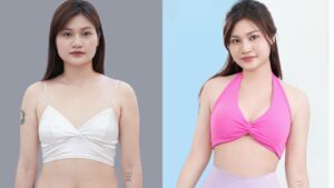 Hút mỡ giữ được bao lâu? Sự thật về kết quả vĩnh viễn và cơ chế tái béo