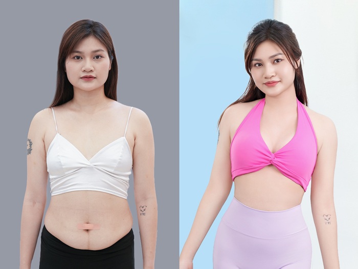 hút mỡ có thể duy trì lâu dài giúp vóc dáng cân đối, đường cong cơ thể hoàn hảo