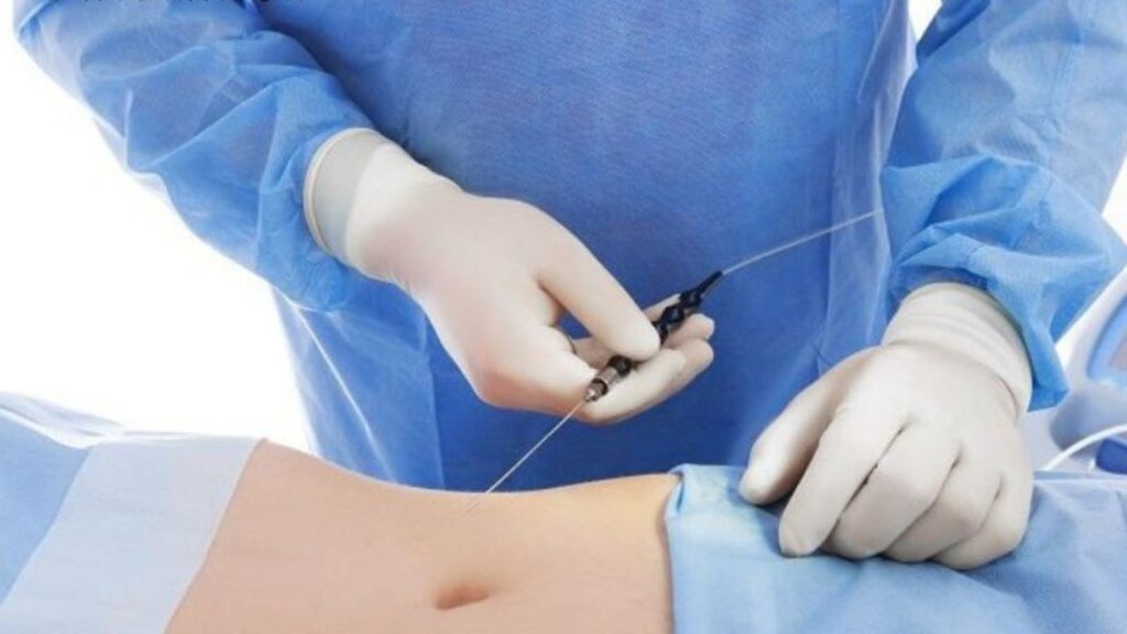 Công nghệ hút mỡ ít đau nhất 2026: So sánh Body Jet, PAL và Lipo 360