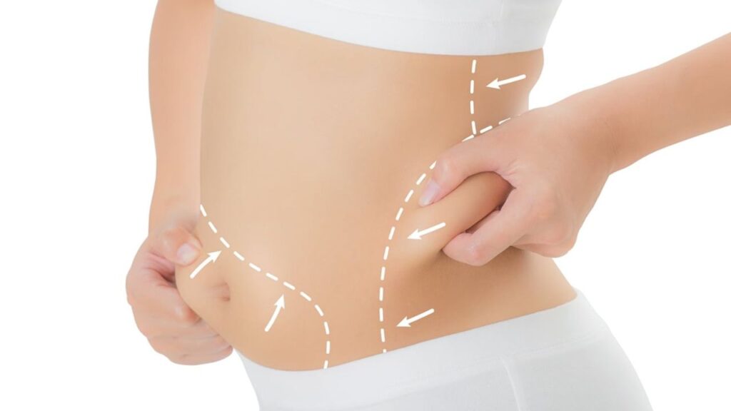 Hút mỡ không đều, lồi lõm: Phác đồ tái cấu trúc bề mặt và thời điểm sửa lỗi an toàn